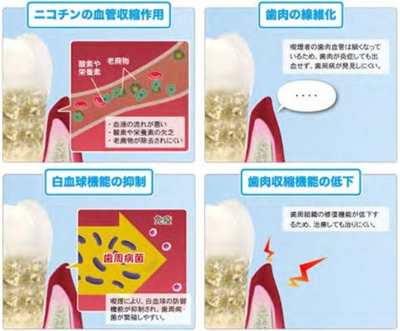 タバコの成分と歯周病の関係