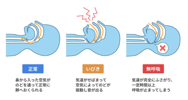 睡眠時無呼吸症候群