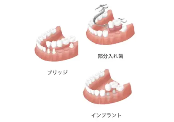 残存歯数と健康寿命の関係