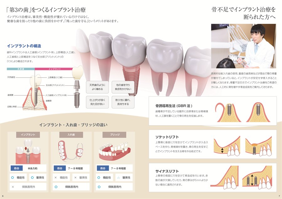 インプラント治療の基本