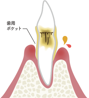 歯周炎（中度）