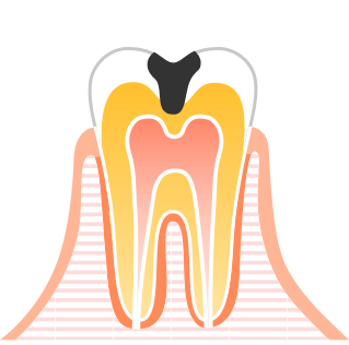 中等度の虫歯